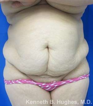 Tummy Tuck Before & After Patient #10477