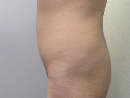 Brazilian Butt Lift Before & After Patient #6364