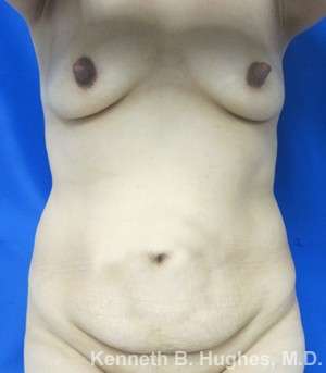 Tummy Tuck Before & After Patient #10485