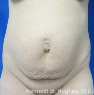 Tummy Tuck Before & After Patient #10508