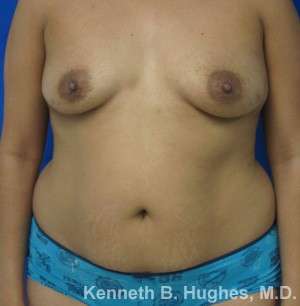 Tummy Tuck Before & After Patient #10517