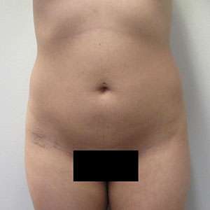 Brazilian Butt Lift Before & After Patient #6369