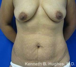 Tummy Tuck Before & After Patient #10526
