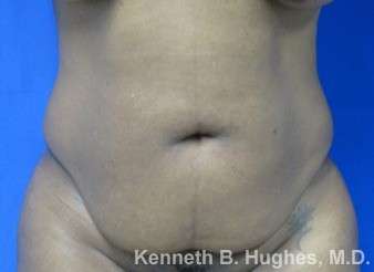 Tummy Tuck Before & After Patient #10531