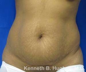 Tummy Tuck Before & After Patient #10539