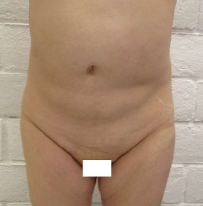 Tummy Tuck Before & After Patient #10542