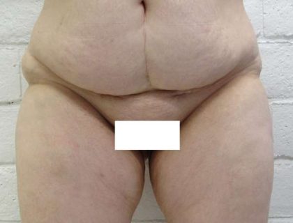 Tummy Tuck Before & After Patient #10545