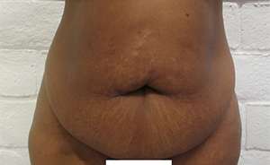 Tummy Tuck Before & After Patient #10548