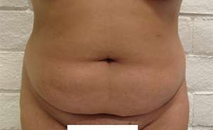 Tummy Tuck Before & After Patient #10551