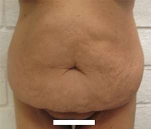 Tummy Tuck Before & After Patient #10554