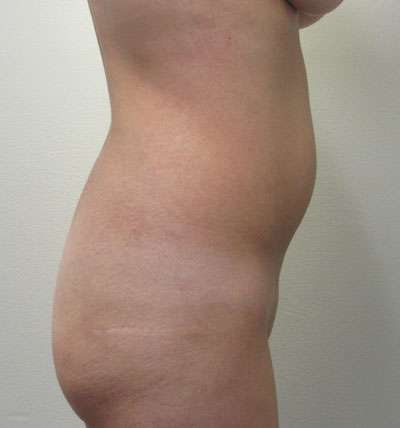 Brazilian Butt Lift Before & After Patient #6378