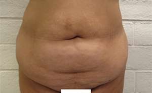 Tummy Tuck Before & After Patient #10557