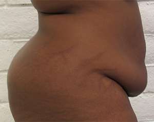Tummy Tuck Before & After Patient #10560