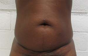 Tummy Tuck Before & After Patient #10566