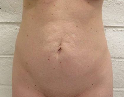 Tummy Tuck Before & After Patient #10569