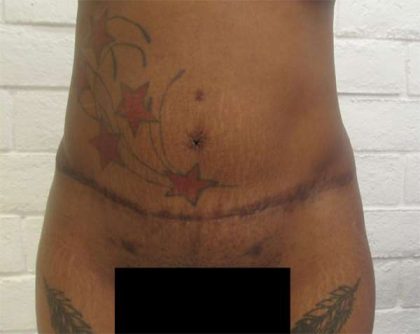 Tummy Tuck Before & After Patient #10572