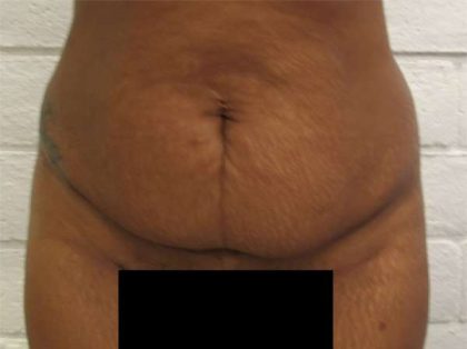 Tummy Tuck Before & After Patient #10575