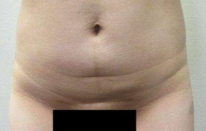Tummy Tuck Before & After Patient #10578