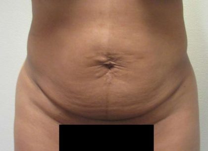 Tummy Tuck Before & After Patient #10588