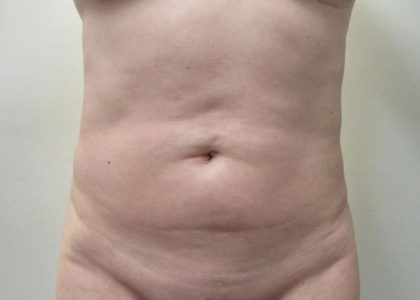 Tummy Tuck Before & After Patient #10591
