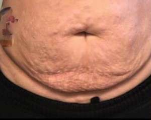 Tummy Tuck Before & After Patient #10594