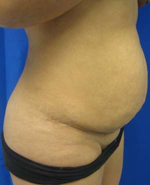Tummy Tuck Before & After Patient #10597