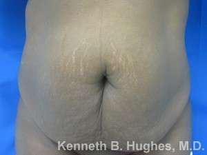 Tummy Tuck Before & After Patient #10604