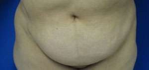 Tummy Tuck Before & After Patient #10607