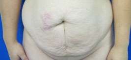 Tummy Tuck Before & After Patient #10610