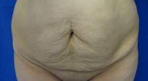 Tummy Tuck Before & After Patient #10613
