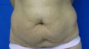 Tummy Tuck Before & After Patient #10616