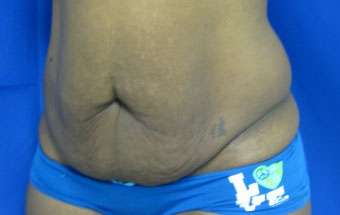 Tummy Tuck Before & After Patient #10619