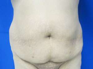 Tummy Tuck Before & After Patient #10628