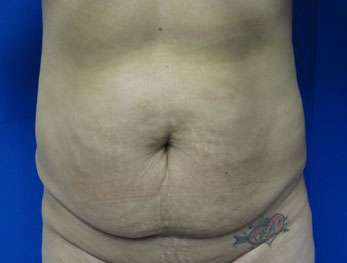 Tummy Tuck Before & After Patient #10631