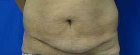 Tummy Tuck Before & After Patient #10634