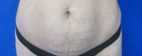 Tummy Tuck Before & After Patient #10639