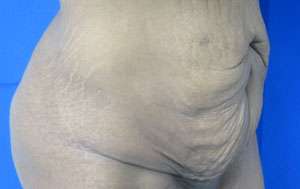 Tummy Tuck Before & After Patient #10642