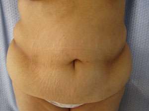 Tummy Tuck Before & After Patient #10651