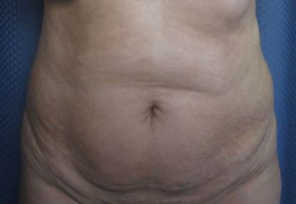 Tummy Tuck Before & After Patient #10654