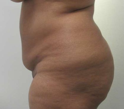 Abdomen Before & After Patient #5886