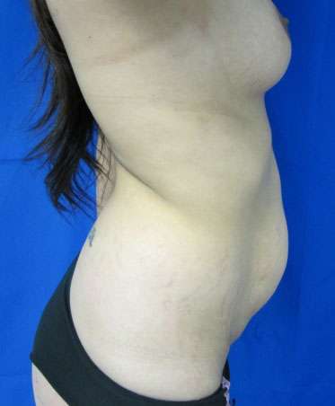 Tummy Tuck Before & After Patient #10657