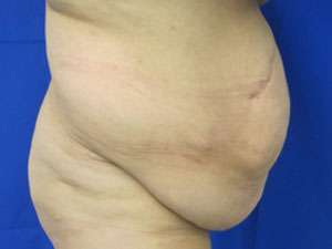 Tummy Tuck Before & After Patient #10660