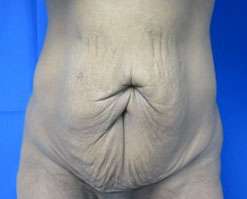 Tummy Tuck Before & After Patient #10663