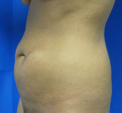 Tummy Tuck Before & After Patient #10666