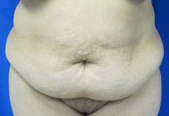 Tummy Tuck Before & After Patient #10669