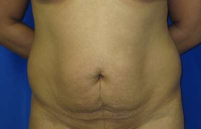 Tummy Tuck Before & After Patient #10672