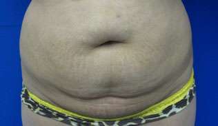 Tummy Tuck Before & After Patient #10675
