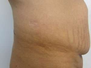 Tummy Tuck Before & After Patient #10681