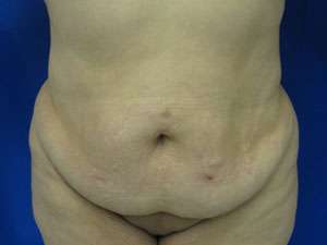 Tummy Tuck Before & After Patient #10684
