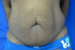 Tummy Tuck Before & After Patient #10687